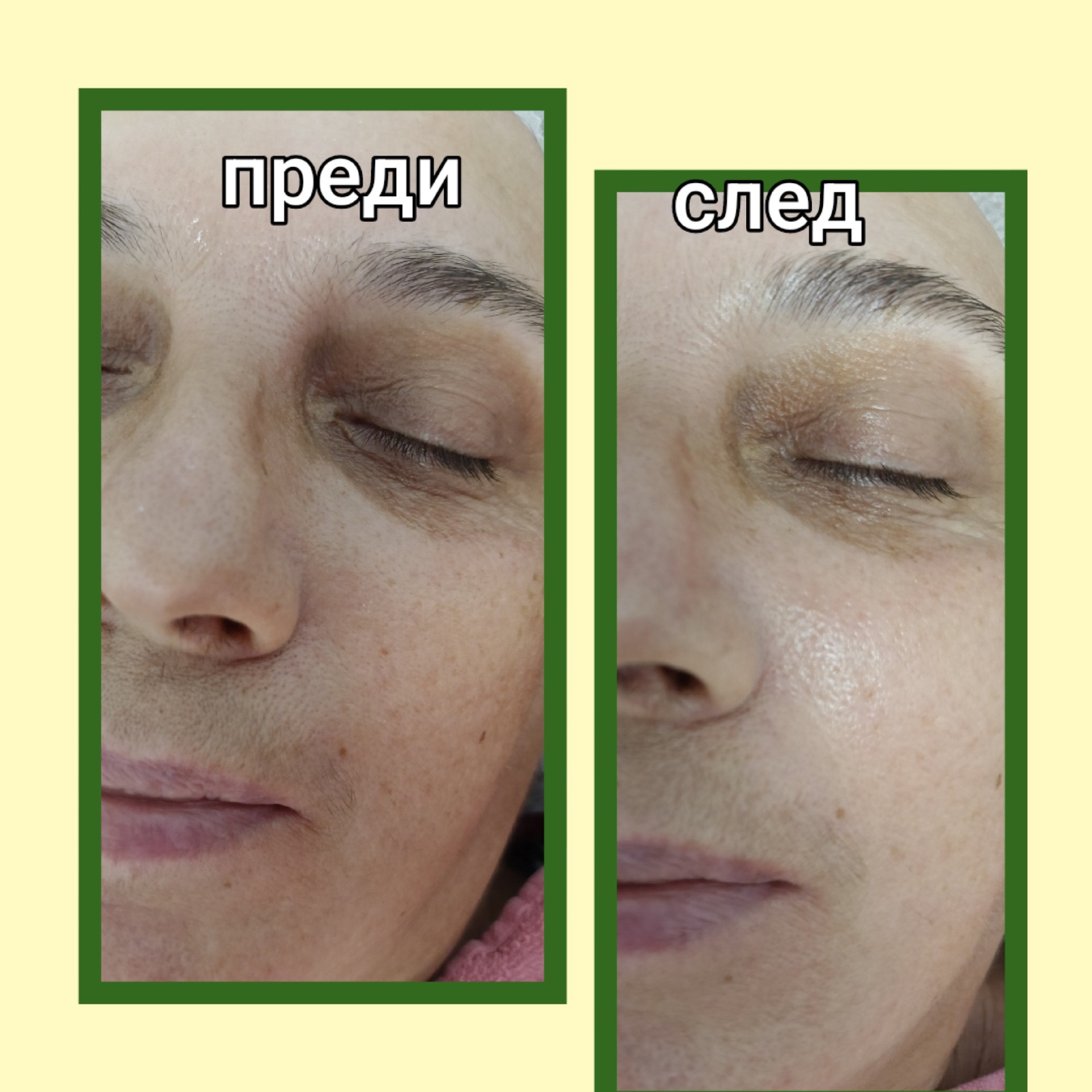 Анти ейдж RF 3Д лифтинг