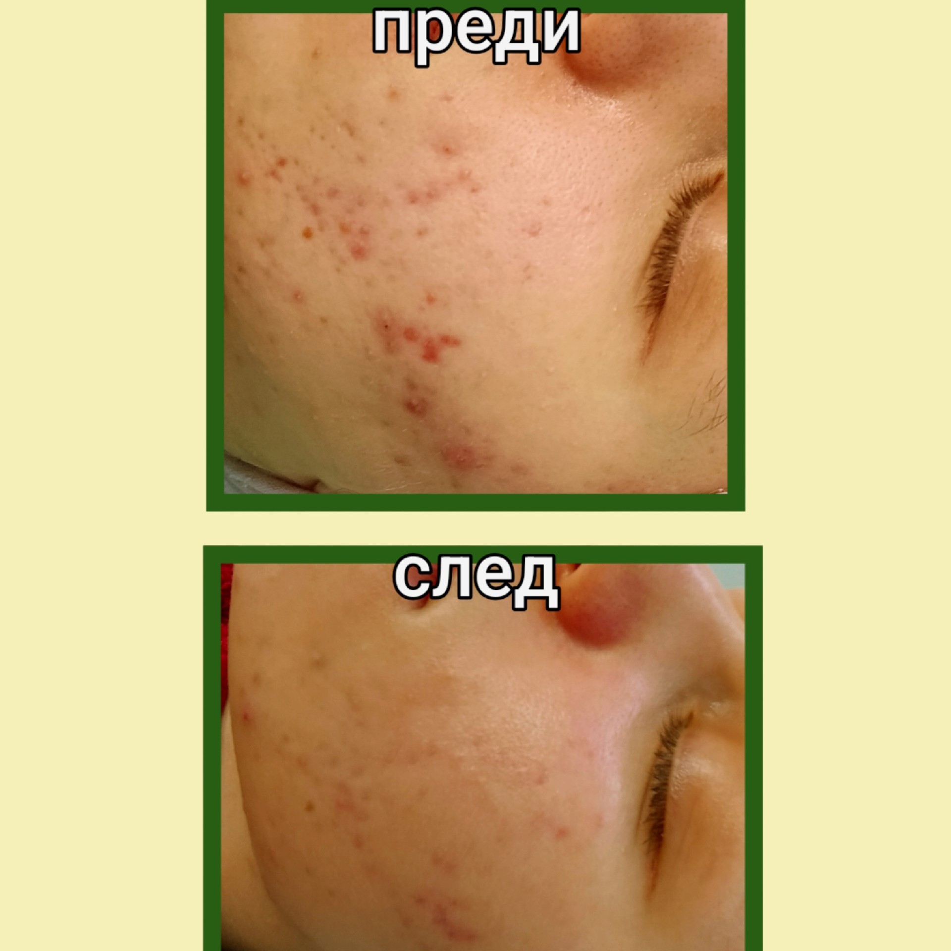 Белези от акне