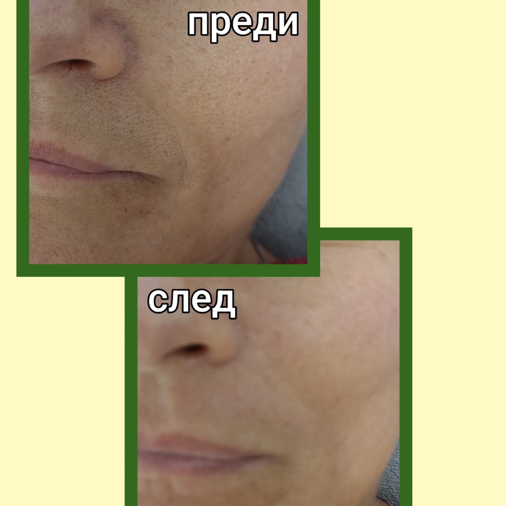 Екзозомна терапия-фейс фитнес