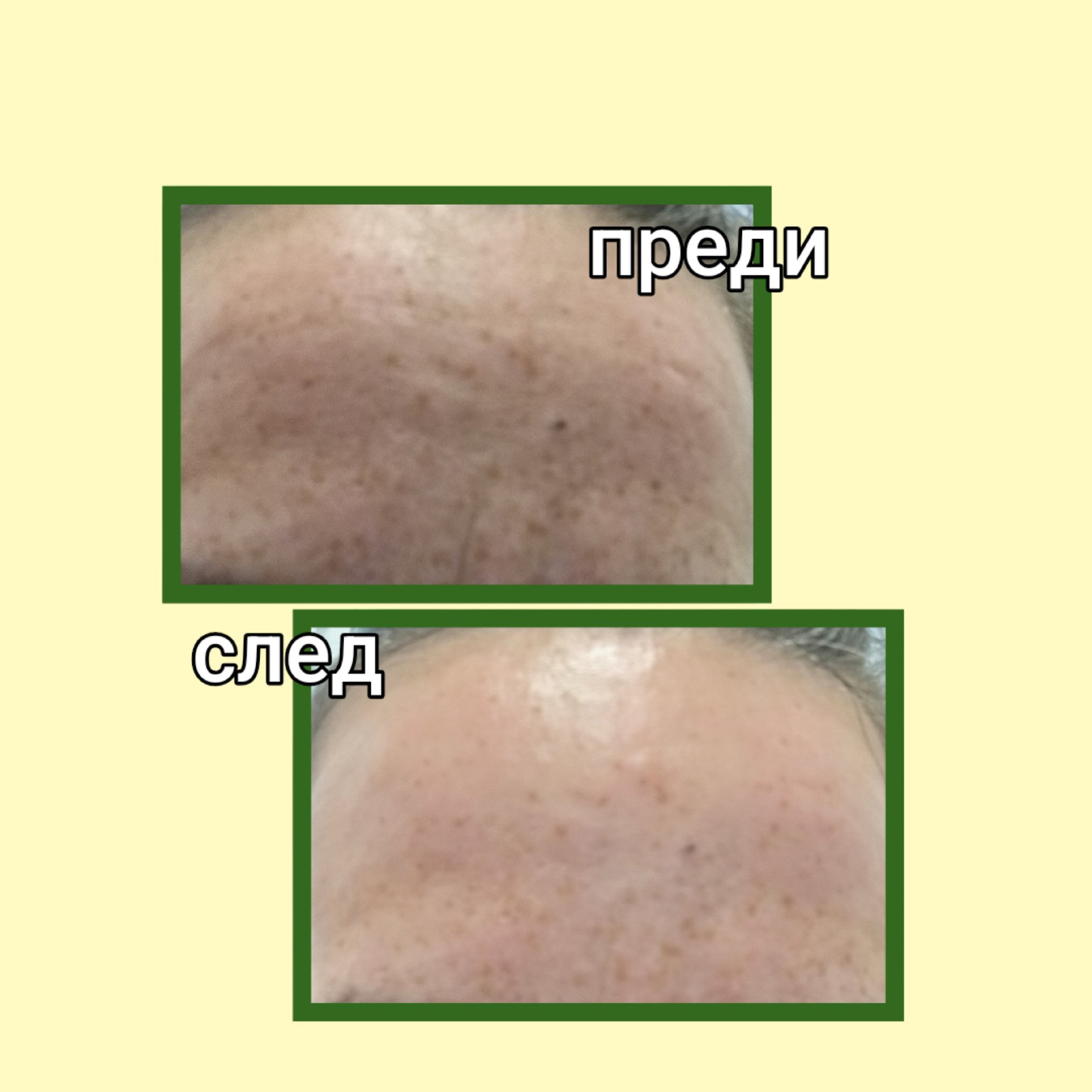 Анти ейдж терапия за лице